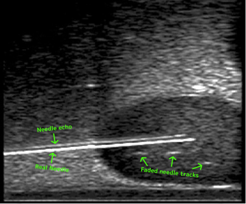 needle penetration Dans l'image de la glande prostatique ci-dessus, il est facile de distinguer entre l'aiguille en cours de pénétration et les anciennes traces d'aiguille :