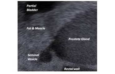BrachyProstatewCatheterP_us-edited.png