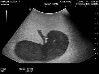 Kidney Phantom image png. Kidney Phantom from Yezitronix Group Inc