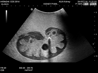 Kidney Phantom image png
