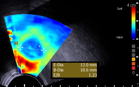 Prostate Elastography