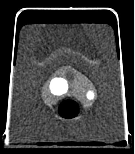 Enlarged Prostate Phantom CT