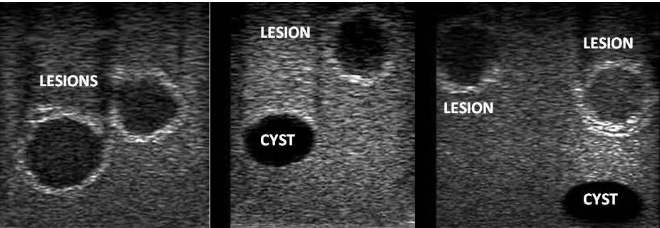 UltrasoundBreastP_us.png