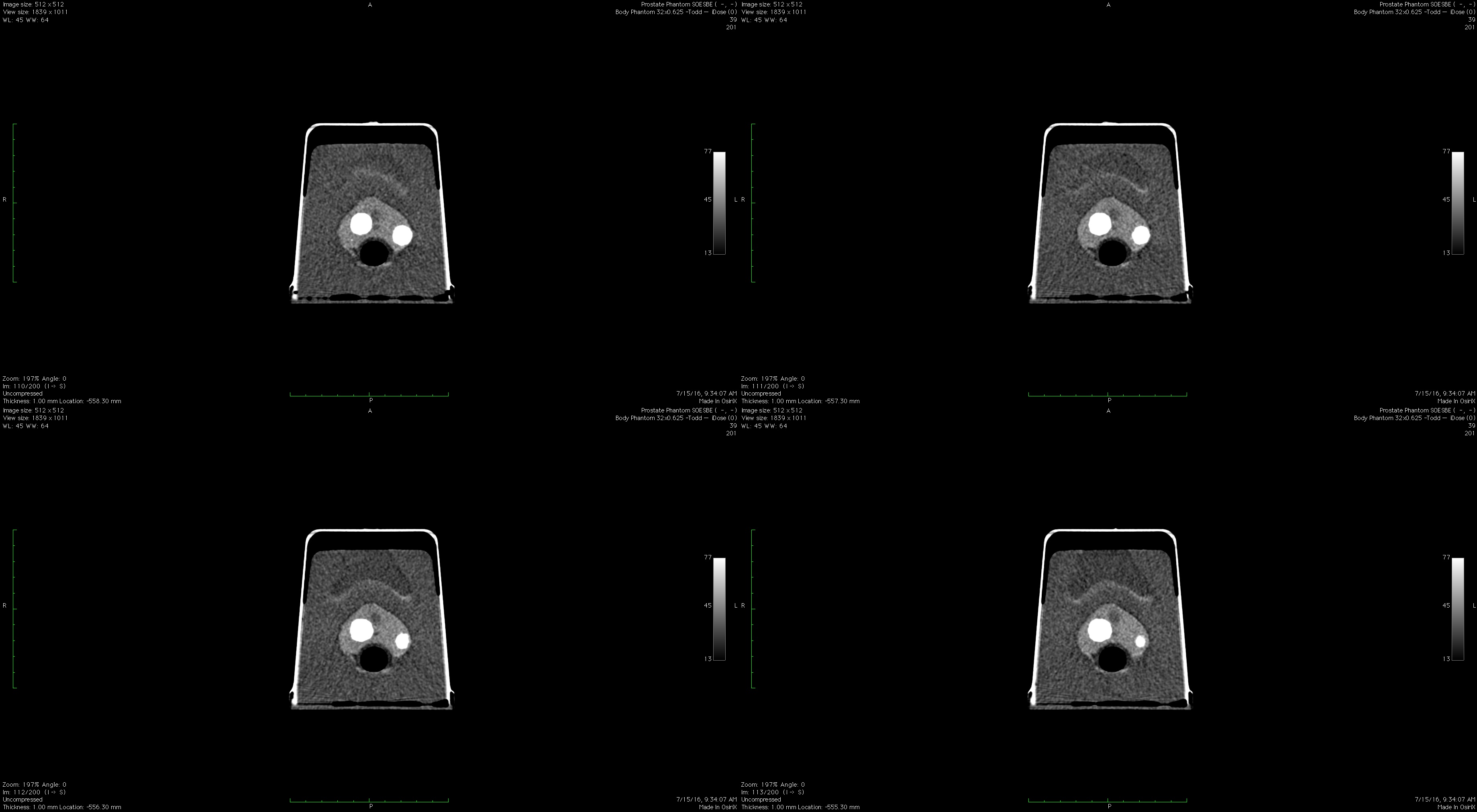 Prostate Phantom CT Transverse Scans